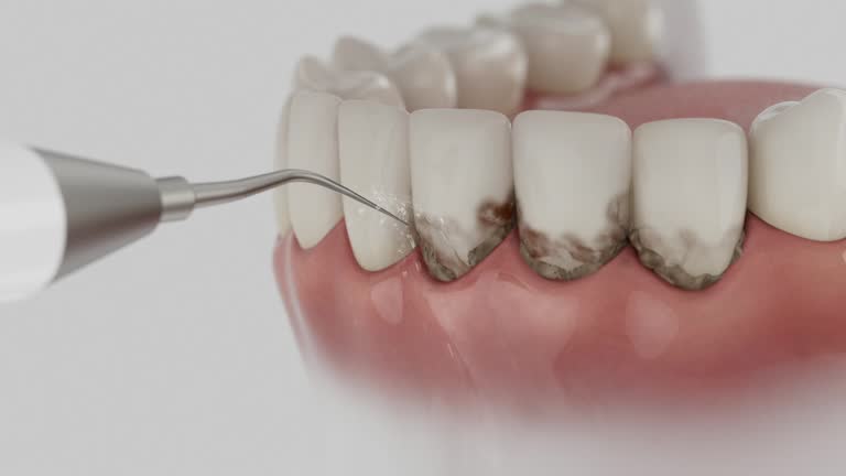 Trusted Wisdom Tooth Removal service in Destin, FL - Dentist Open Now